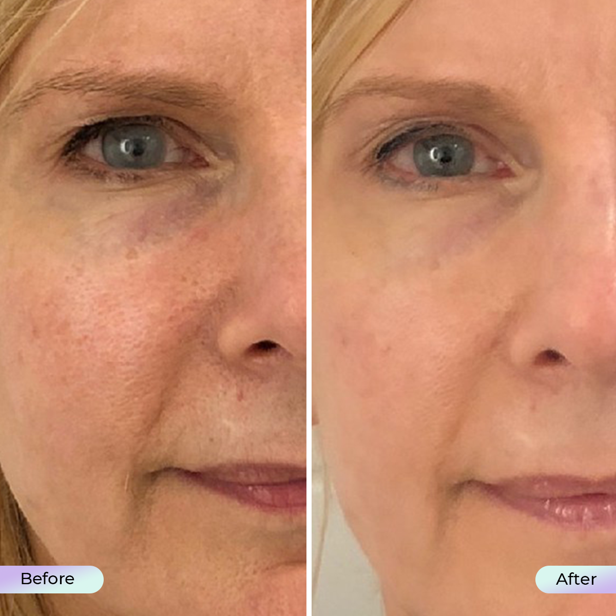 Summersale: Aduro Facial Mask + Free Aduro Palm V1