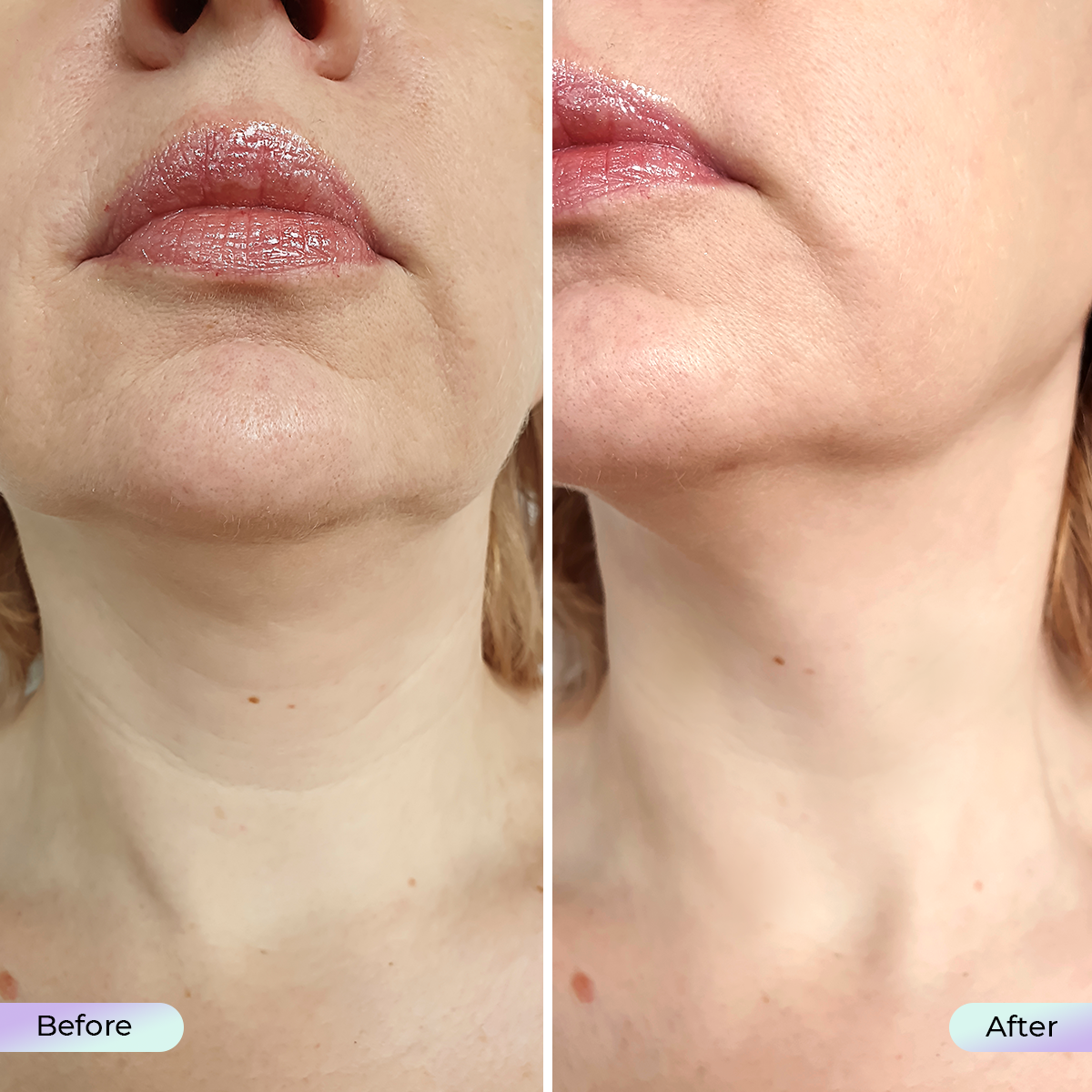 Summersale: Aduro Neck and Décolleté Mask + Free Aduro Palm V1