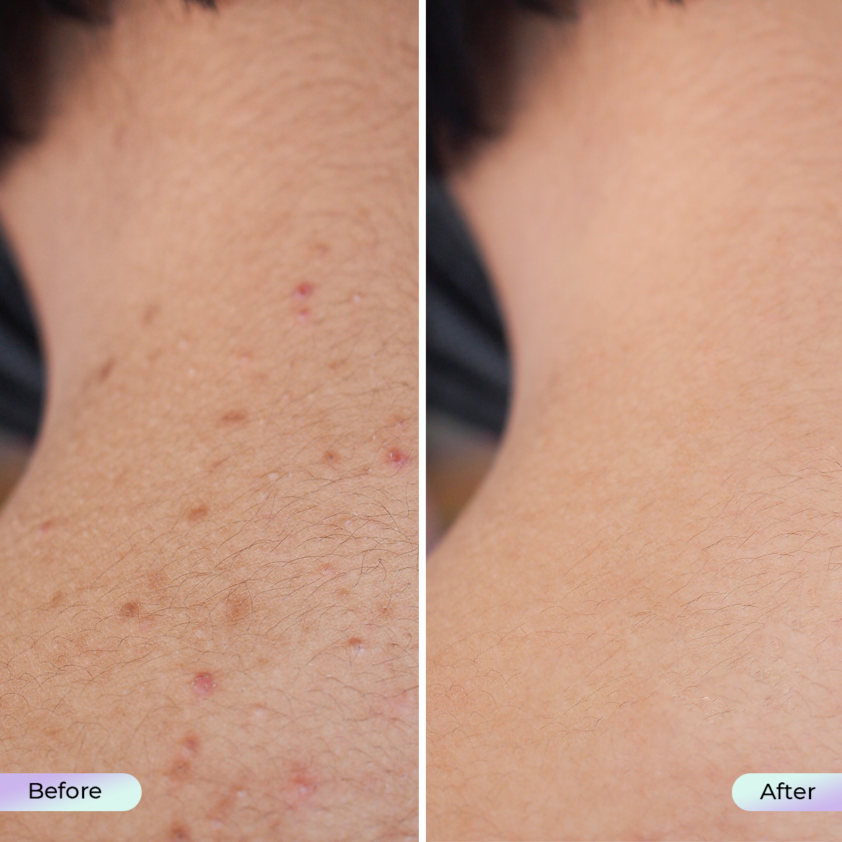 Summersale: Aduro Neck and Décolleté Mask + Free Aduro Palm V1
