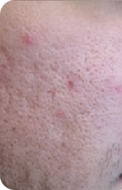 Aduro before and after Acne-causing bacteria